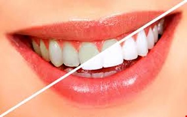 رژیم غذایی چه تاثیری در ایجاد پوسیدگی دندان ها دارد؟