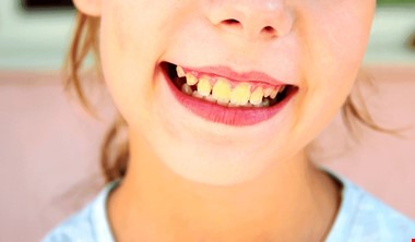 چگونه در خانه زردی دندان را از بین ببریم؟