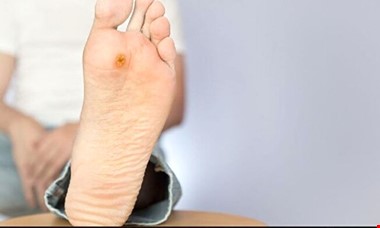 علائم این بیماری خطرناک که روی پاها خود را نشان می‌دهد!