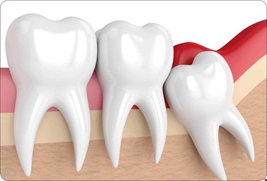 دندان نهفته درمان دارد؟