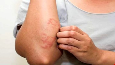ضایعات پوستی وحشتناک ناشی از بیماری گوارشی