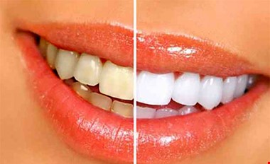 ۵ اشتباه مهلک که باعث زردی دندان‌ها می‌شود