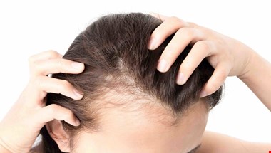 ۲۰ دلیل اصلی ریزش مو پیدا شد + راهحل