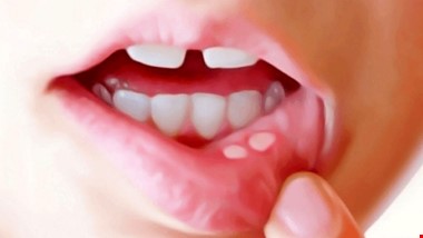 بهترین درمان آفت دهان