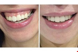 لبخند لثه‌ای و اصلاح آن با بوتاکس