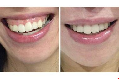 لبخند لثه‌ای و اصلاح آن با بوتاکس