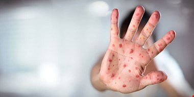 زنگ خطر «سرخک» در شمال کشور