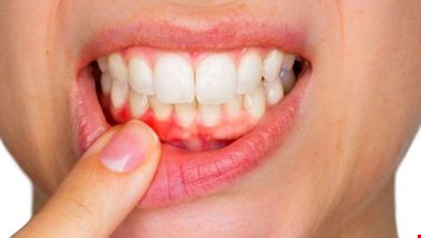 علائمی که می گوید بیماری لثه دارید