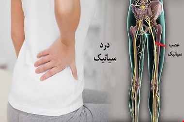 سیاتیک را با گرفتگی عضلات اشتباه نگیرید