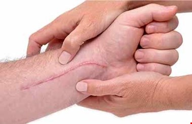 چرا جای زخم روی پوست می ماند؟ / این کرم ها را استفاده نکنید