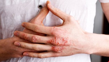 نسخه طب سنتی در درمان اگزما