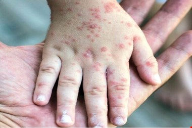 مرگ یک نوزاد در کانادا بر اثر سرخک در بحبوحه شیوع سراسری