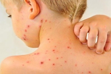 صدور هشدار سرخک برای شمال سیدنی